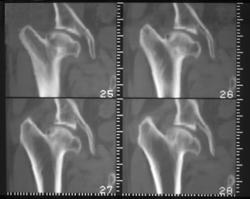 Diastrophic Dwarf - CTisus CT Scan