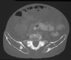 Fibrous Dysplasia - CTisus CT Scan