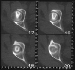 Avascular Necrosis (AVN) Femoral Head - CTisus CT Scan