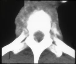 Osteomyelitis - CTisus CT Scan