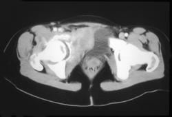 Aneurysmal Bone Cyst (ABC) - CTisus CT Scan