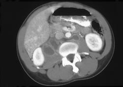 Psoas Abscess - CTisus CT Scan