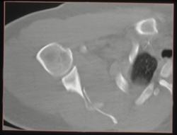 Scapular Fracture - CTisus CT Scan