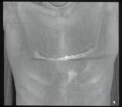 Repaired Failed Pectus Repair - CTisus CT Scan