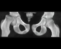 Slipped Capital Femoral Epiphysis (SCFE) - CTisus CT Scan