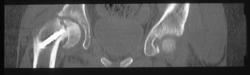 Failed Repair of Slipped Capital Femoral Epiphysis (SCFE) - CTisus CT Scan