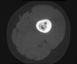 Osteoid Osteoma - CTisus CT Scan