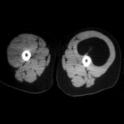 Two Examples of Lipoma of the Thigh - CTisus CT Scan