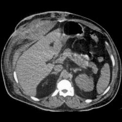 Actinomycosis - CTisus CT Scan