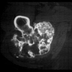 Chondrosarcoma - CTisus CT Scan