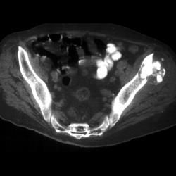 Chondrosarcoma Arising in An Osteochondroma - CTisus CT Scan