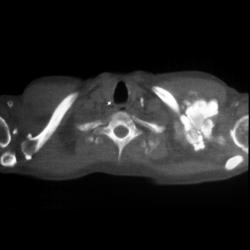 Tumoral Calcinosis - CTisus CT Scan