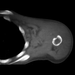 Osteomyelitis - CTisus CT Scan