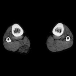 Hemangioma - CTisus CT Scan