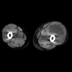 Hematoma - CTisus CT Scan