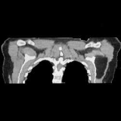 Lipoma - CTisus CT Scan