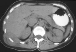 Lymphoma of the Rib - CTisus CT Scan