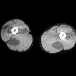 Neurofibromatosis - CTisus CT Scan