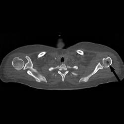 Osteomyelitis - CTisus CT Scan