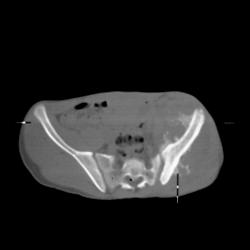 Osteosarcoma in Radiated Bone - CTisus CT Scan