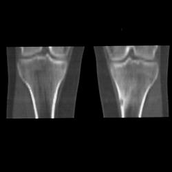 Osteoid Osteoma - CTisus CT Scan