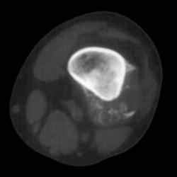 2 Examples of the Various Appearances of Osteosarcoma - CTisus CT Scan