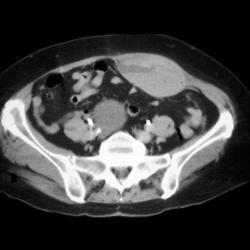 Rectus Hematoma - CTisus CT Scan