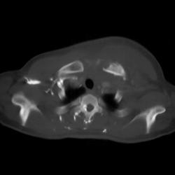 Osteomyelitis in Sternoclavicular Joint (SC Joint) With Abscess - CTisus CT Scan