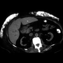 Dermatomyositis - CTisus CT Scan