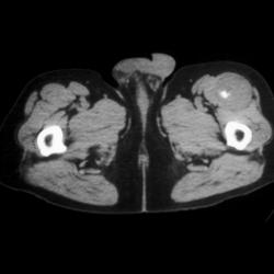 Mesenchymoma - CTisus CT Scan