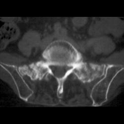 Stress Fracture - CTisus CT Scan