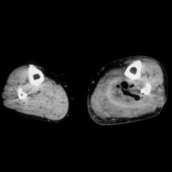 Intramuscular Abscess - CTisus CT Scan