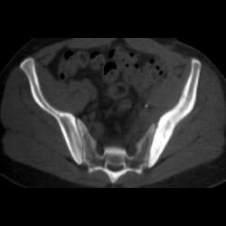 Primary Lymphoma of Bone - CTisus CT Scan