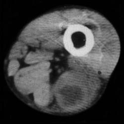 2 Cases of Intramuscular Abscess - CTisus CT Scan