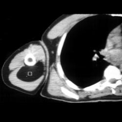 2 Examples of Lipoma With Various Appearances - CTisus CT Scan