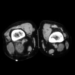 Neurofibromatosis - CTisus CT Scan