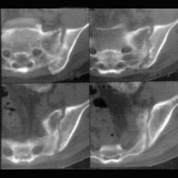 2 Examples of Osteomyelitis - CTisus CT Scan