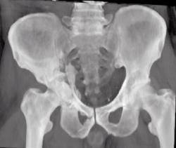 Acetabular Fracture - CTisus CT Scan