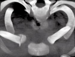 Clavicular Head Fracture - CTisus CT Scan