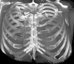 3D of Medial Sternotomy and Banding - CTisus CT Scan