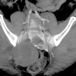 Chordoma - CTisus CT Scan