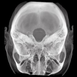 Normal 3D of Base of Skull - CTisus CT Scan