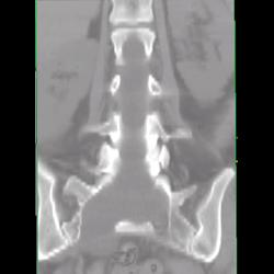 Marfan With Dural Ectasia - CTisus CT Scan