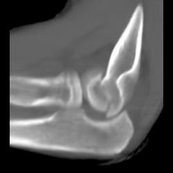 Capitellum Fracture - CTisus CT Scan