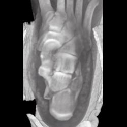 Calcaneal Fracture - CTisus CT Scan