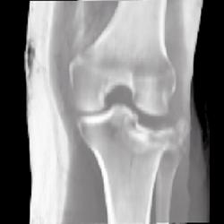 Tibial Plateau Fracture - CTisus CT Scan