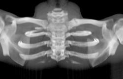 Clavicle Fracture - CTisus CT Scan