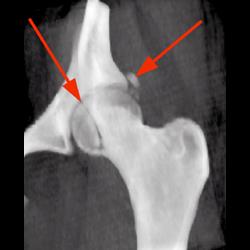 Femoral Head Fracture - CTisus CT Scan