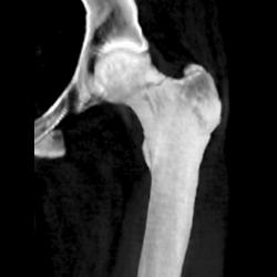 Femoral Neck Fracture - CTisus CT Scan