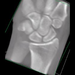 Radial Fracture - CTisus CT Scan